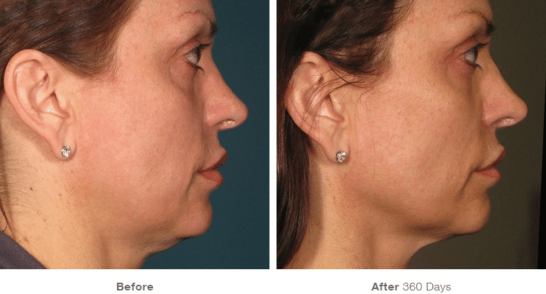 Ultherapy, Face Lift, Non-surgical Lift