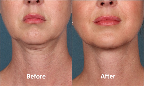 KYBELLA Patient Before and After (Front view)