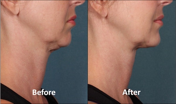 KYBELLA Patient Before and After (Side View)