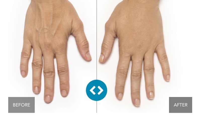 radiesse hands