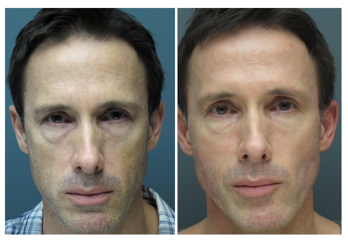 Sculptra For Men | Dr. Jose Raul Montes | Aesthetic Medicine