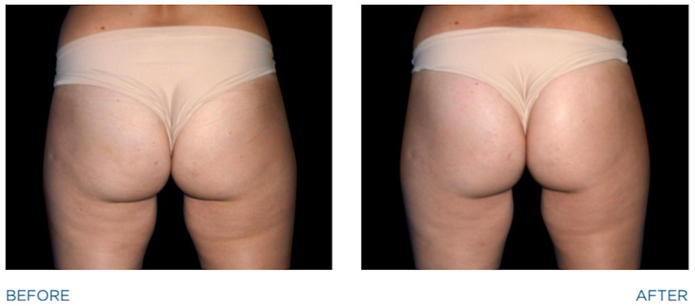 emsculpt before and after image of woman's buttocks
