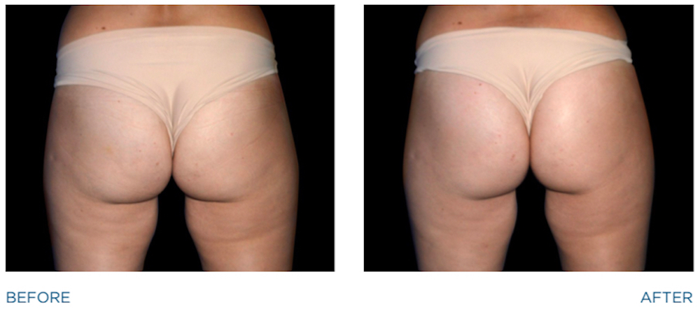 EmSculpt ® - AB tightening procedure. Redifine The Fit In Fitness - Montes