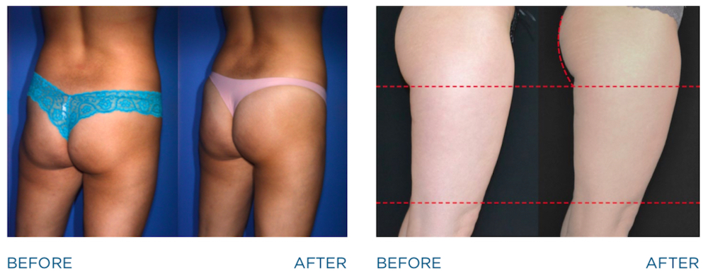 emsculpt before and after image of woman's butt lift