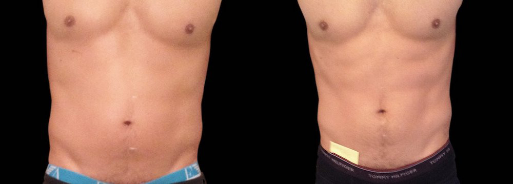 emsculpt on man's abs after 4th treatment