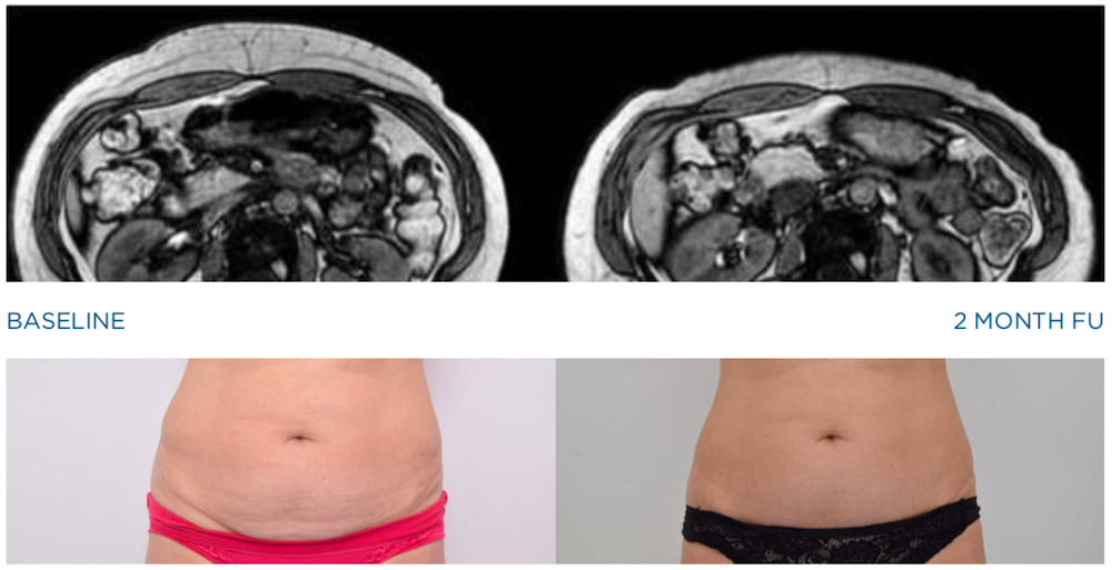 emsculpt mri study images 2 months after treatment