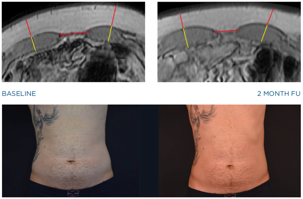 emsculpt mri images of male abdomen