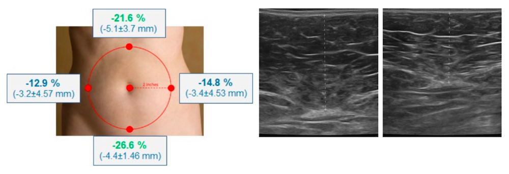 emsculpt ultrasonography study highlights