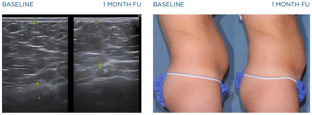 emscupt before and after images of ultrasonography on abdomen