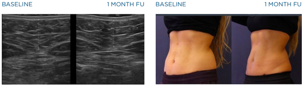 emscupt before and after images of abdomen 1 month after treatment