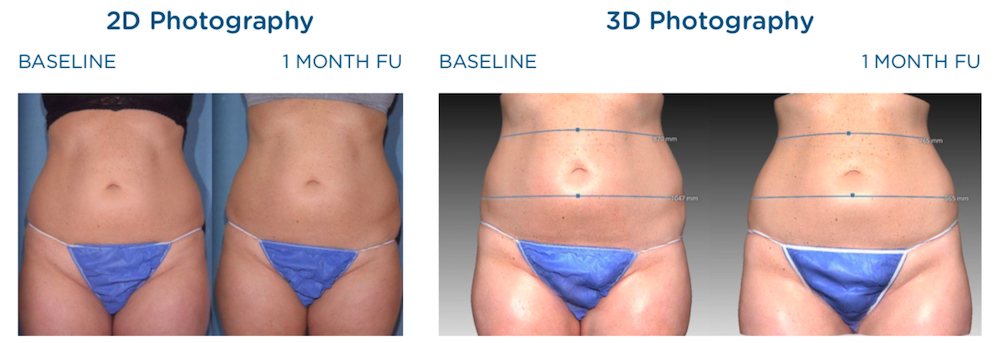 emscupt before and after abdomen images on 2d and 3d photography