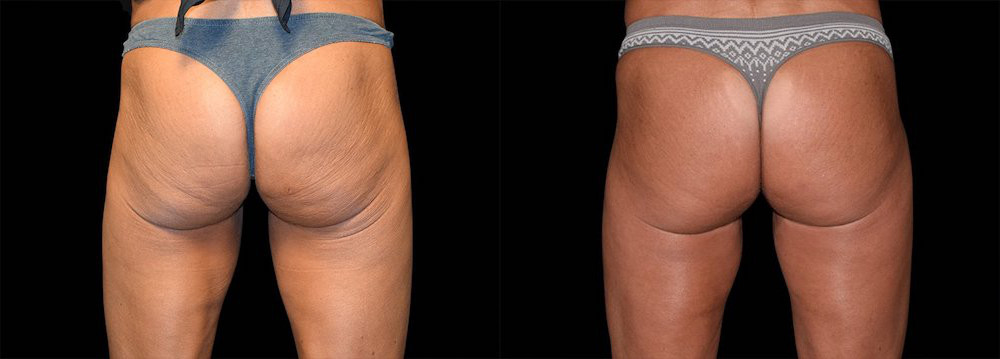 emsculpt a non invasive butt lift treatment