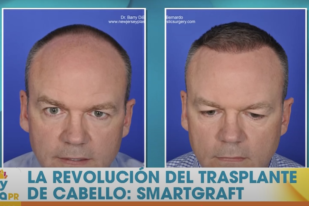 SmartGraft la solución definitiva contra la pérdida de cabello